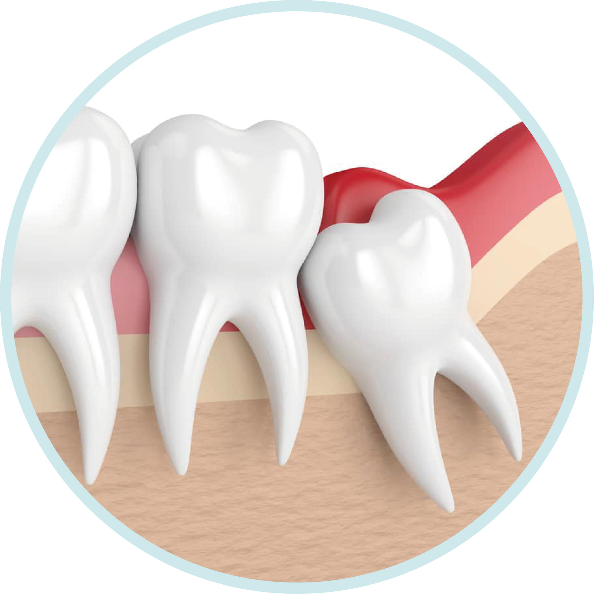 Wisdom Tooth Extraction