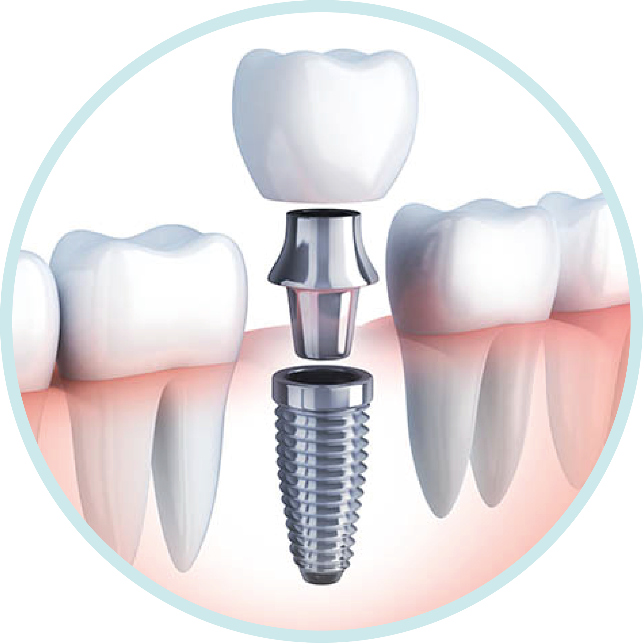 Dental Implants