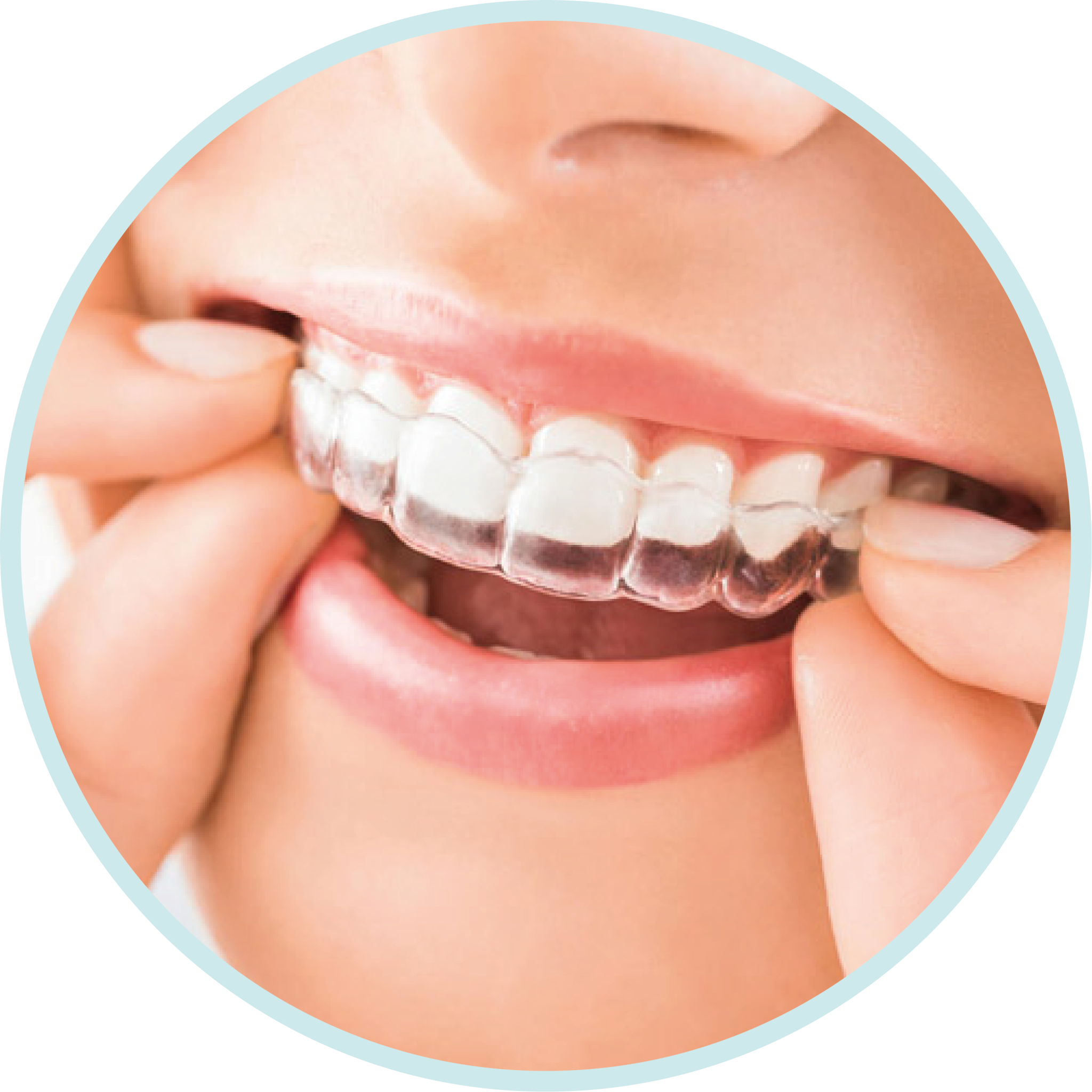 Invisalign & Other Aligners