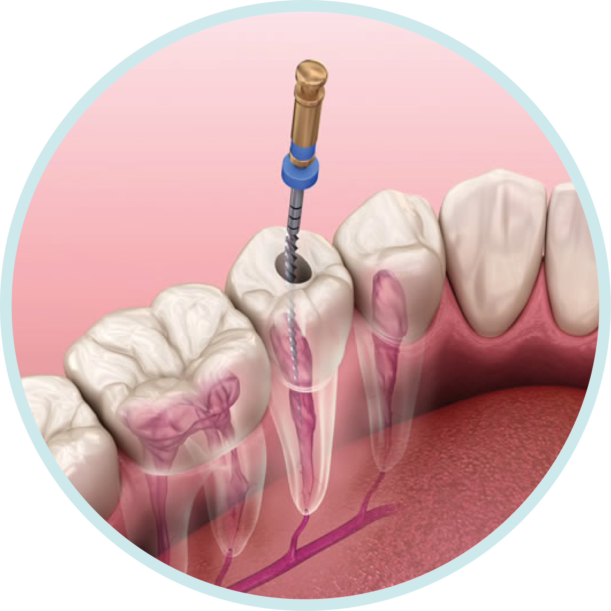 RCT ( Root Canal Treatment)